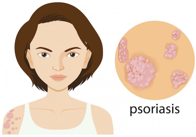 Psoriasis-causes-treatment-snaana